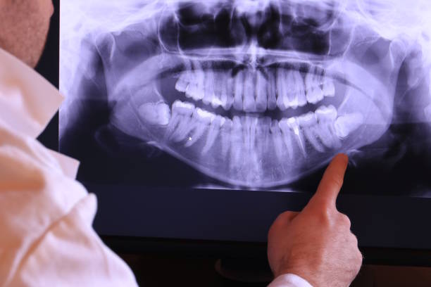 Best Emergency Wisdom Teeth Removal in Cornwall, PA